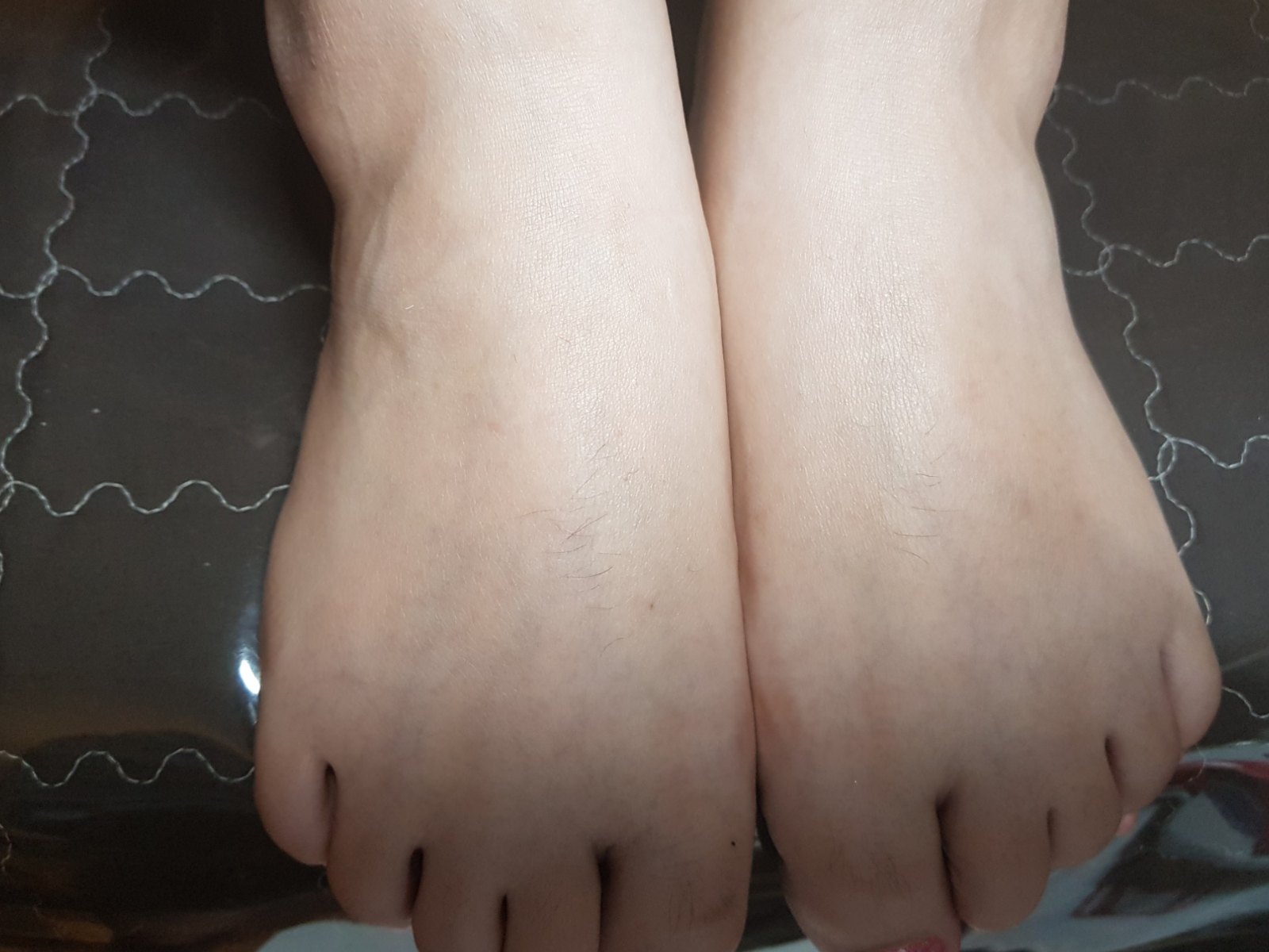 시술 전 — 발가락 왁싱