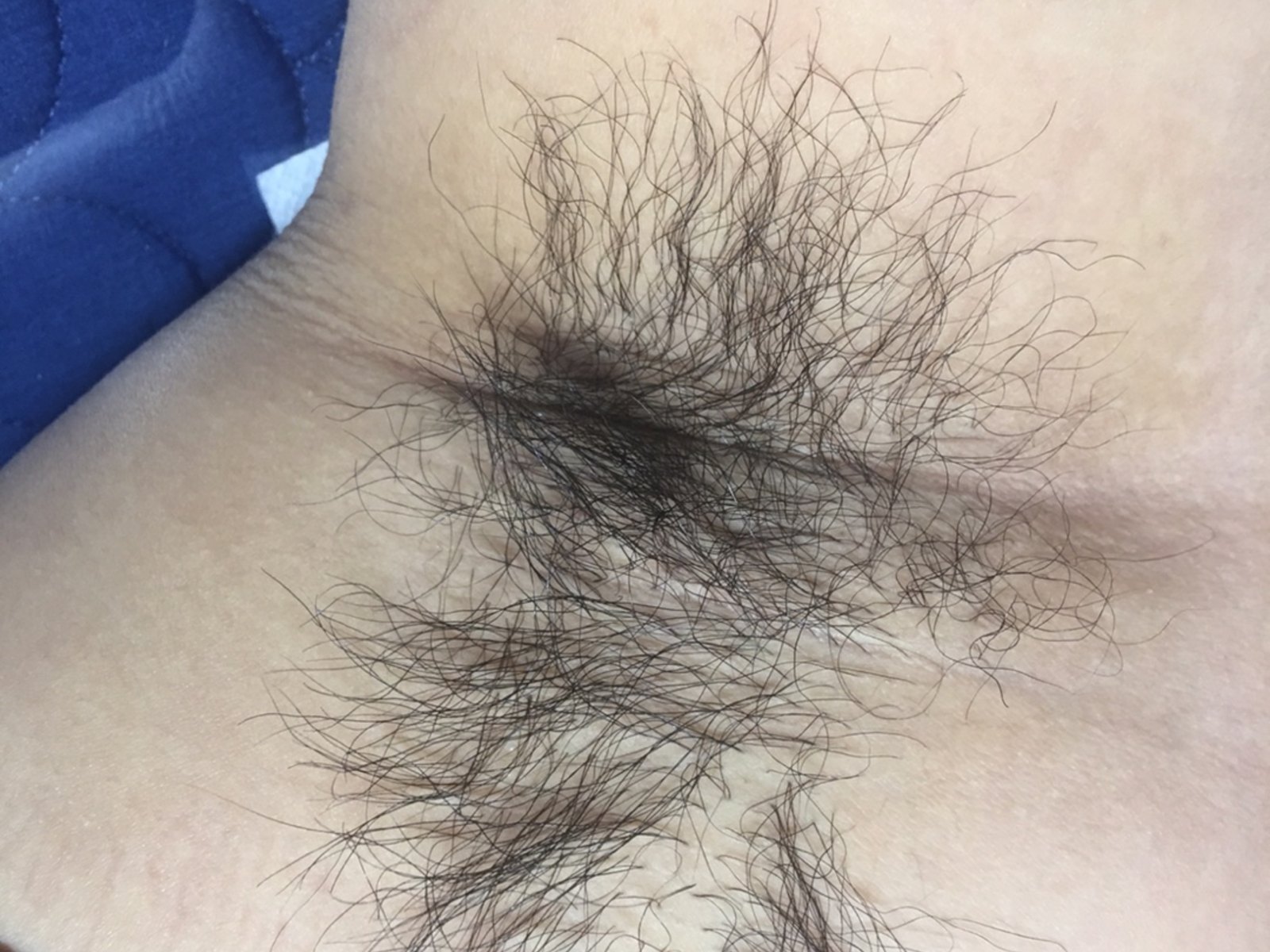 시술 전 — 겨드랑이 왁싱
