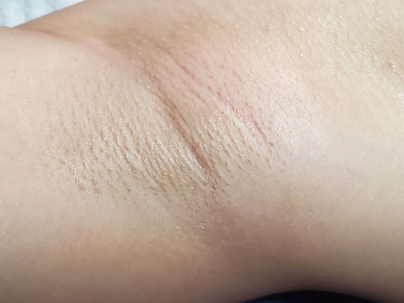 시술 후 — 겨드랑이 왁싱