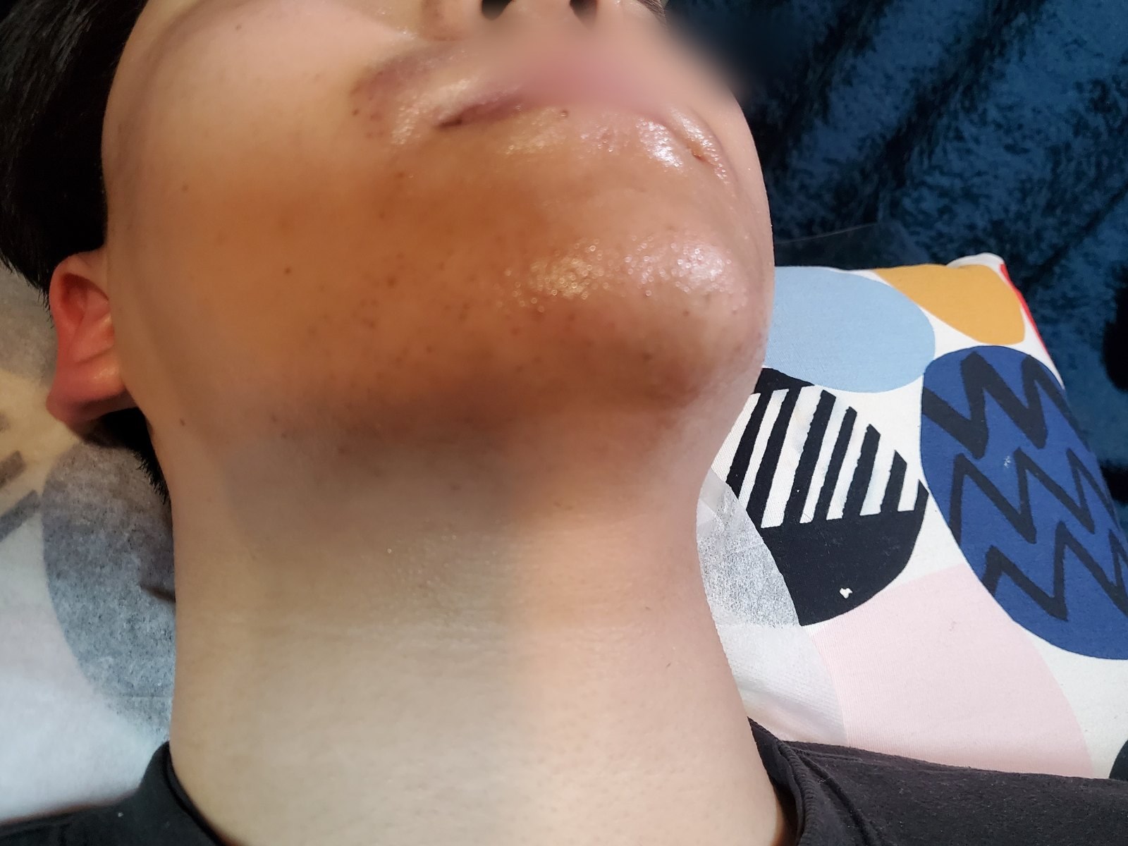시술 후 — 턱 왁싱