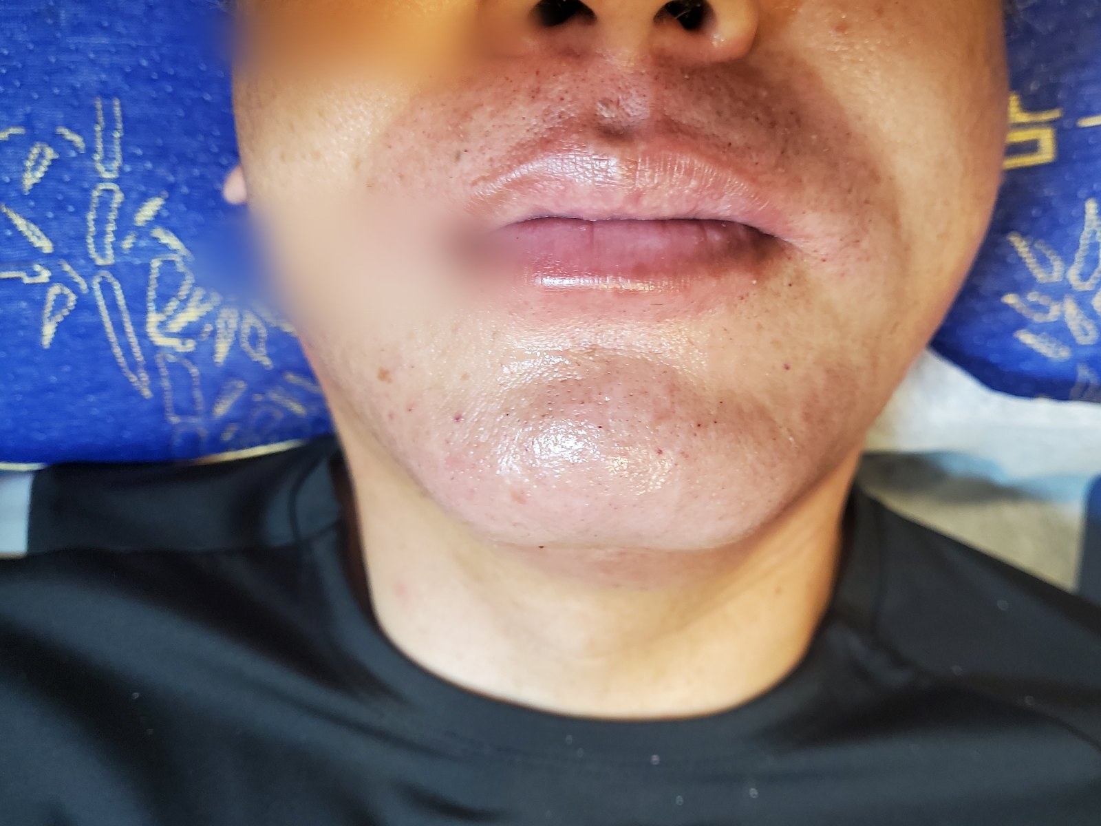 시술 후 — 인중 · 턱 왁싱