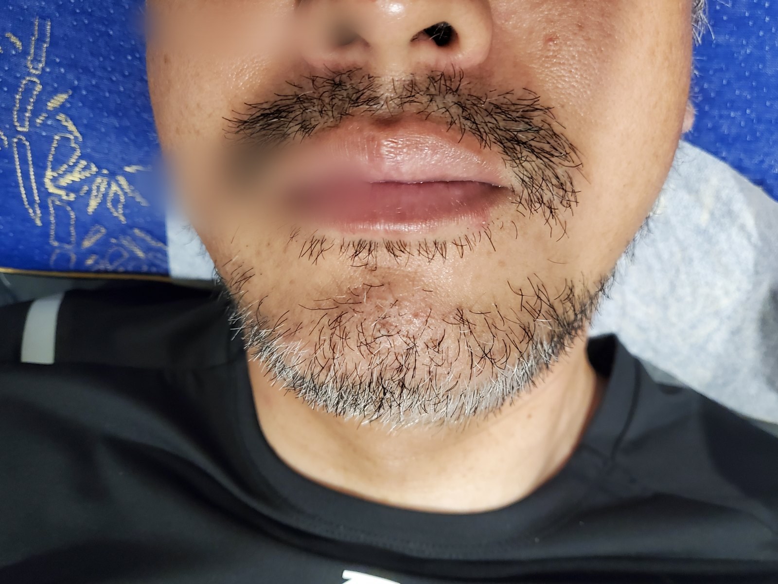 시술 전 — 인중 · 턱 왁싱