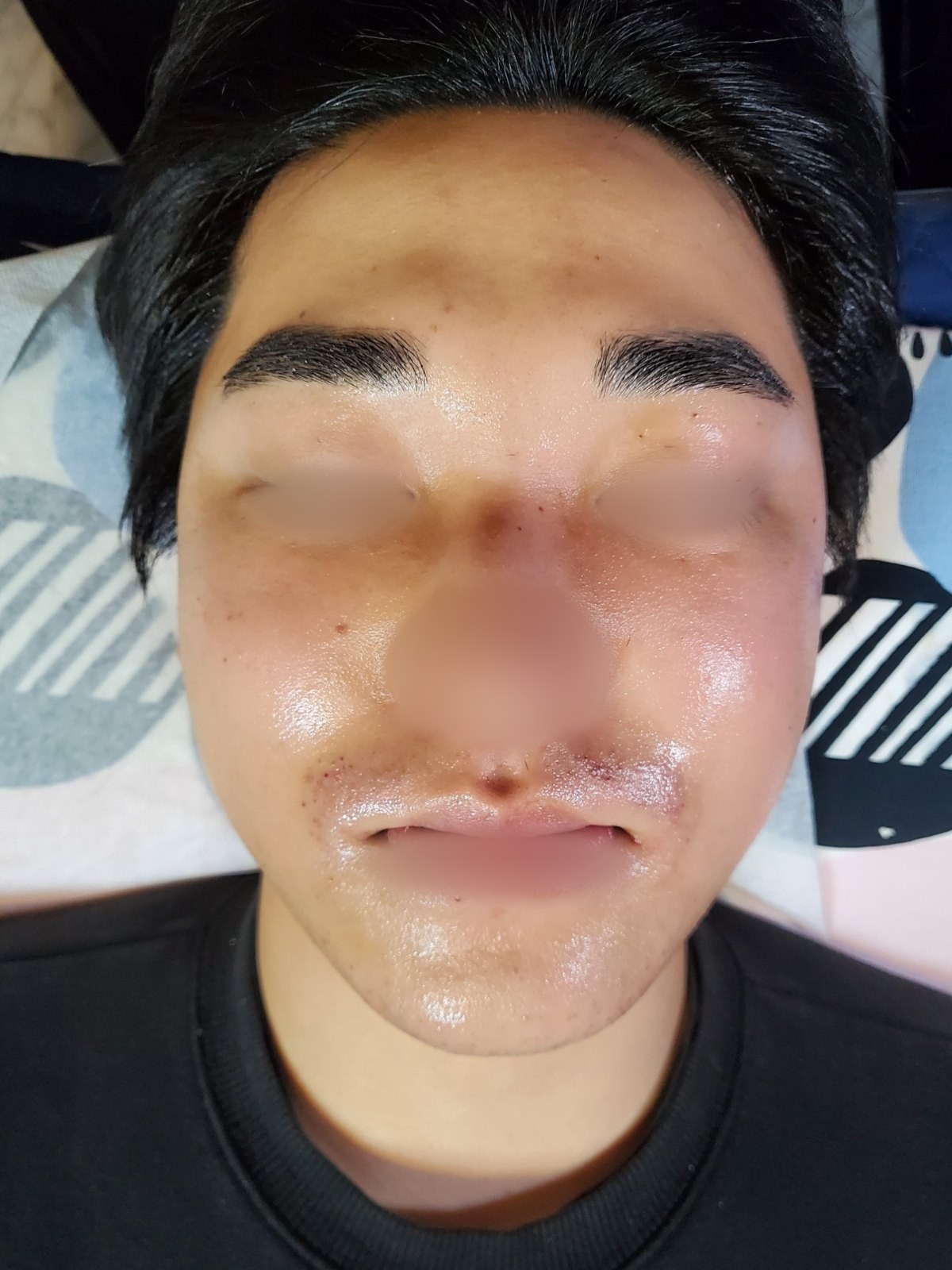 시술 후 — 얼굴 전체 왁싱