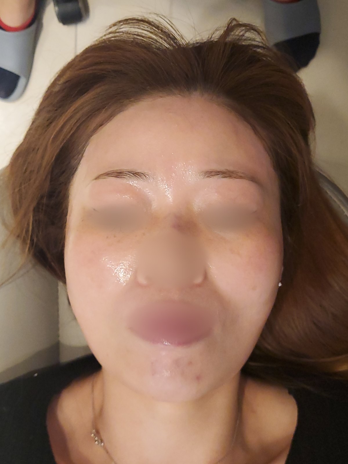 시술 후 — 얼굴 전체 왁싱