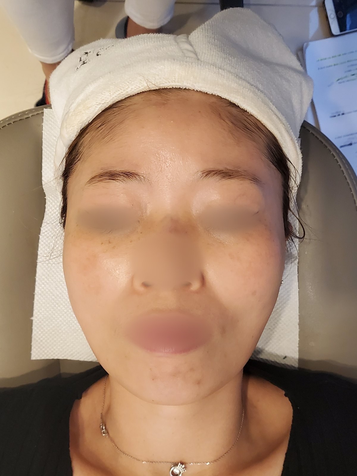 시술 전 — 얼굴 전체 왁싱