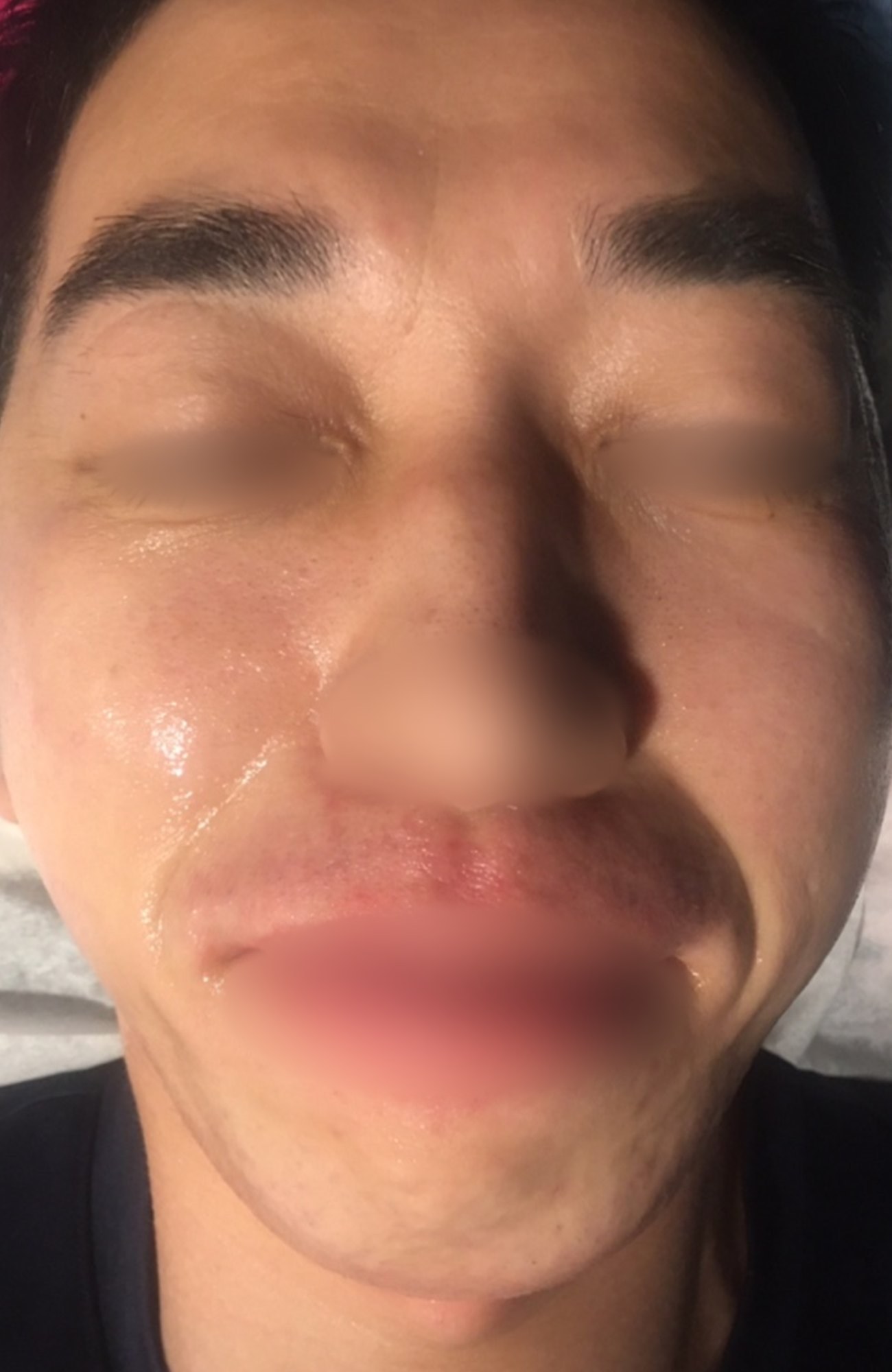 시술 후 — 얼굴 전체 왁싱