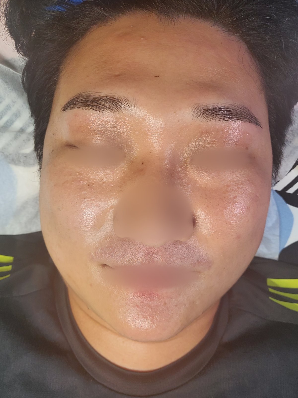 시술 후 — 얼굴 전체 왁싱