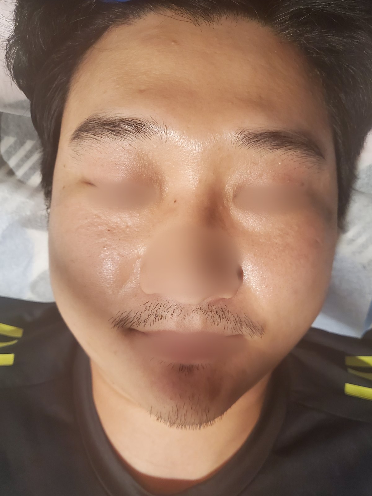 시술 전 — 얼굴 전체 왁싱