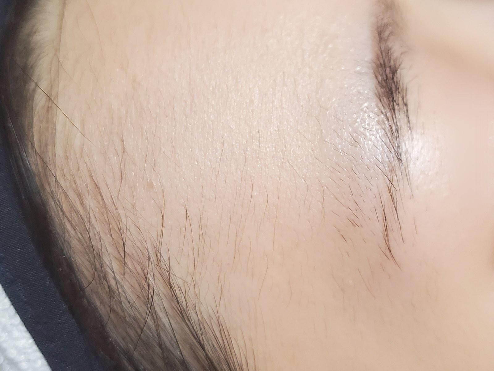시술 전 — 헤어라인 · 이마 왁싱