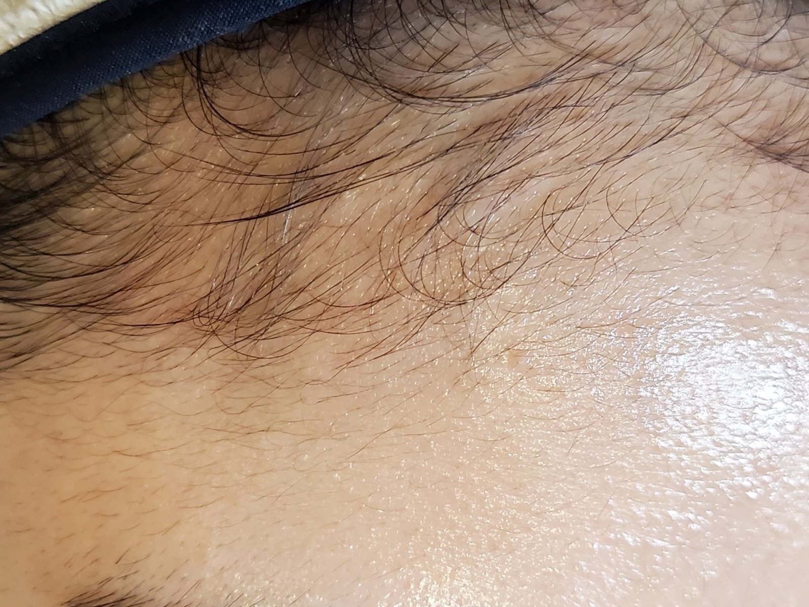 시술 전 — 헤어라인 · 이마 왁싱