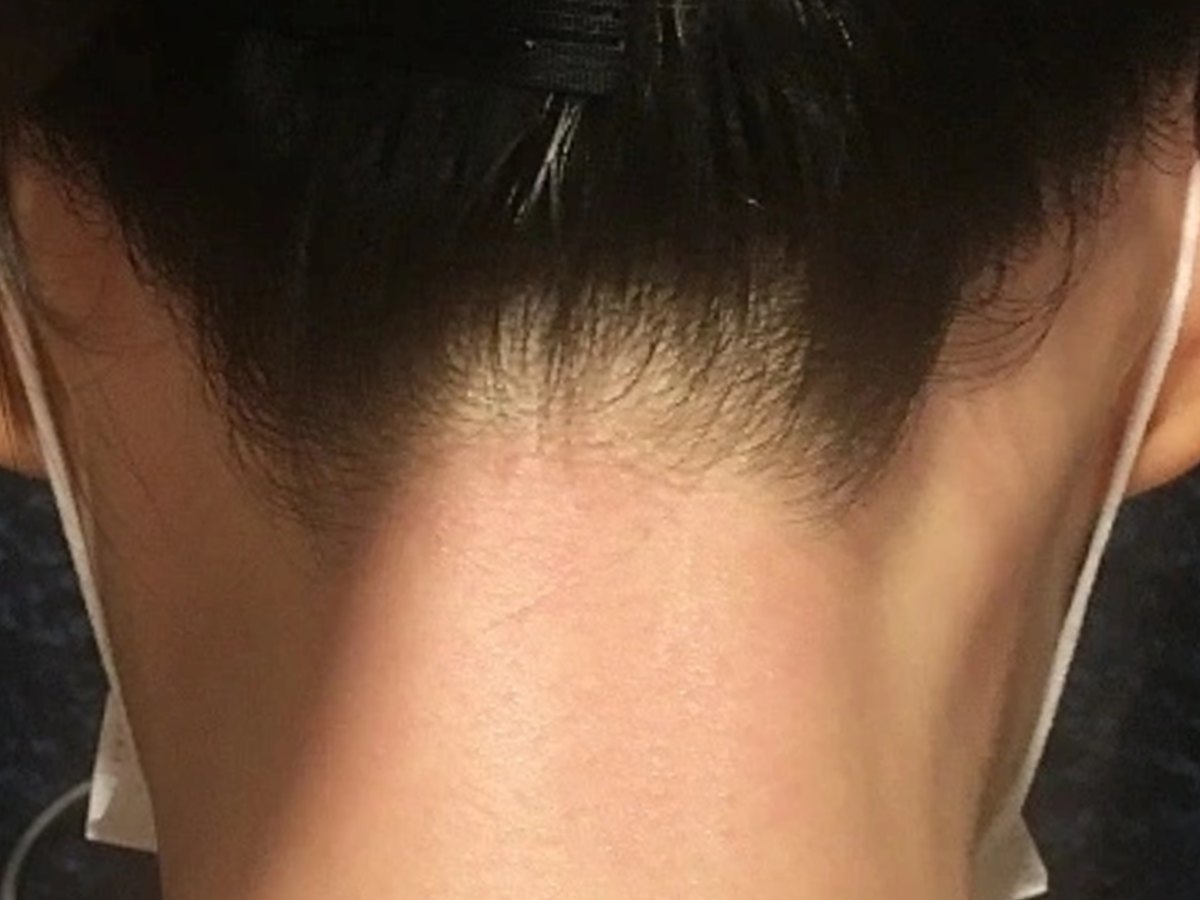 시술 후 — 뒷목 왁싱