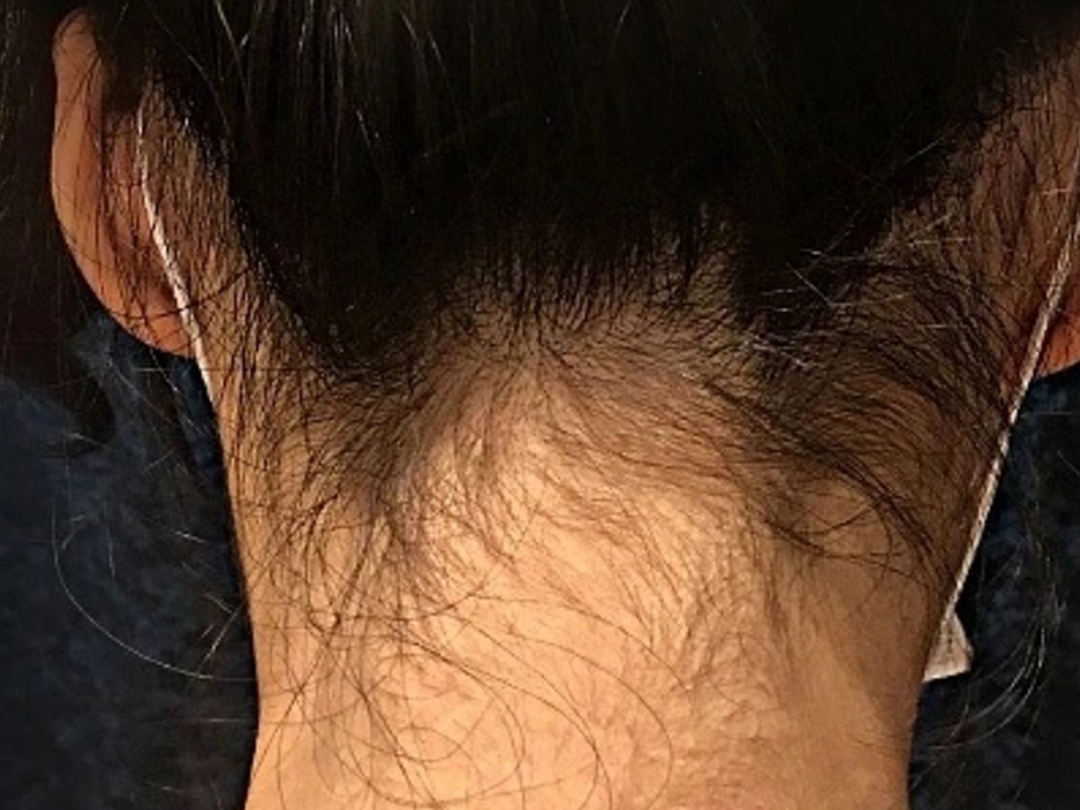 시술 전 — 뒷목 왁싱