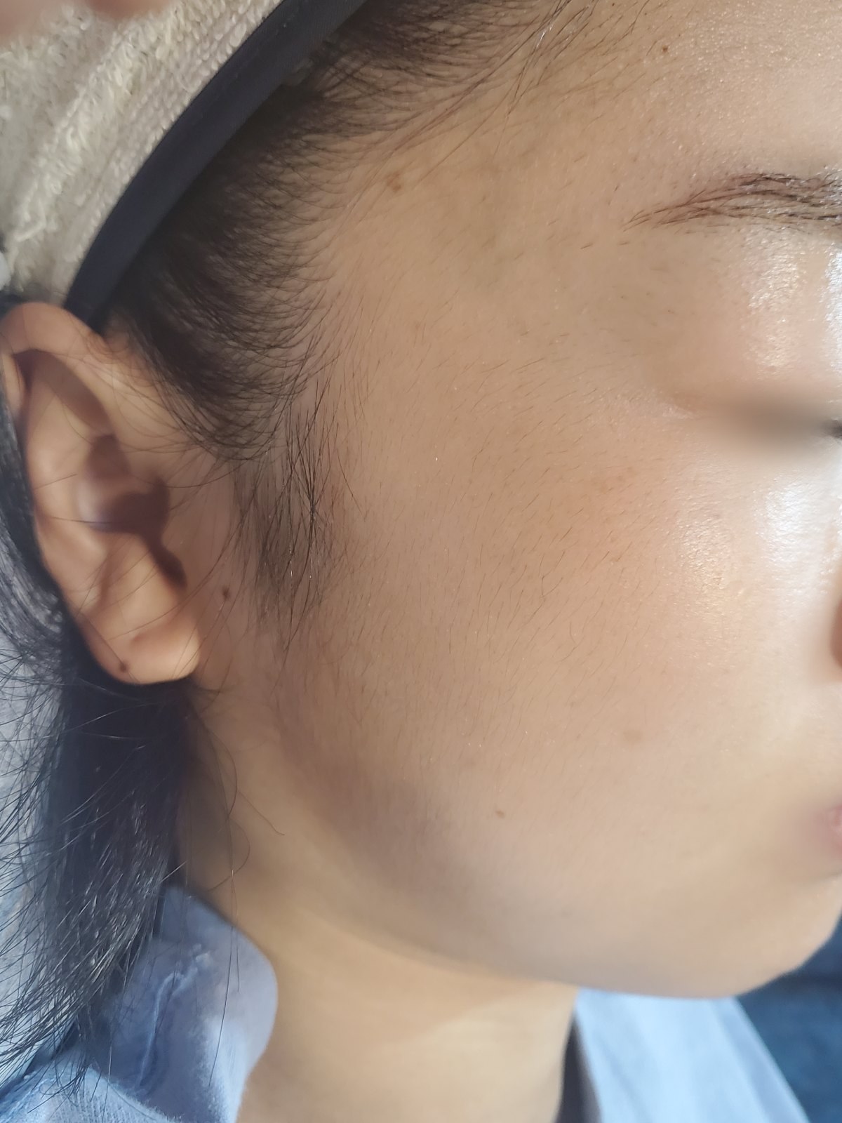 시술 전 — 구렛나루 왁싱